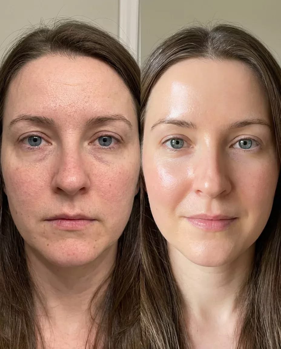 Advanced Anti-Aging: The Role of Collagen Stimulators and Botox