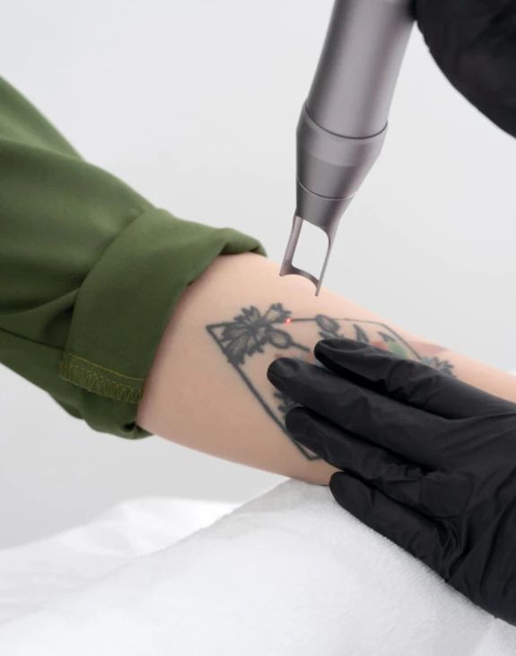 Tattoo Removal: How Q-Switched Nd:YAG Laser Safely Erases Ink