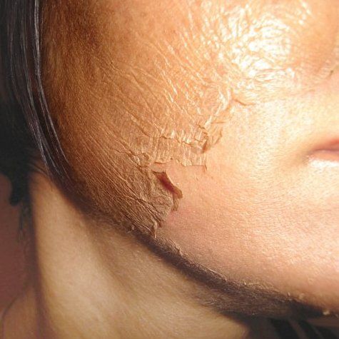 Salicylic Peel