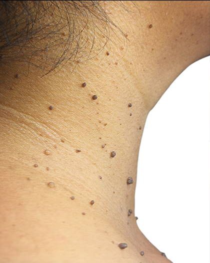 Precision Dermatosurgery
