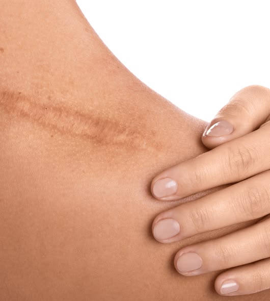 Keloid Scar Treatment