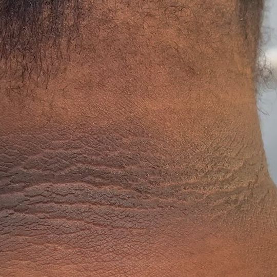 Dark Neck Pigmentation