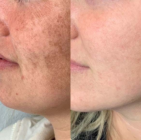 Pigmentation Treatment